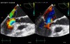 Eclipsed Functional Mitral Regurgitation as a Main Cause of Acute Pulmonary Oedema
