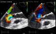 Eclipsed Functional Mitral Regurgitation as a Main Cause of Acute Pulmonary Oedema