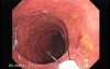 Huge Mass Of The Descending Colon (12 of 25)