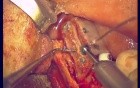 Regeneration Of Multialveolar Process (Left-Side) (1/3)