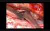 Spinal Cord Tumor - Spinal Intradural Meningioma - Microsurgical Excision