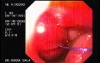 Intraluminal Endoscopic Suturing - Visualization of the Threads