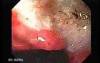 Two Ulcers in a Cirrhotic Patient - Giant Ulcer at the Lesser Curvature