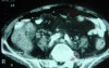 Pseudomembranous Colitis (11 of 11)