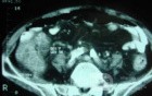 Pseudomembranous Colitis (11 of 11)