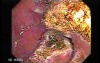 Multiple Adenomatous Polyps Of The Rectum (13 of 37)