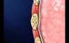 Post Accident Rib Fractures and Subsequent Hemothorax