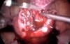 Miomectomy - Cystectomy