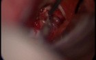 Craniopharyngioma - Right Pterional Approach With Pituitary Stalk Sparing