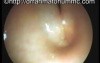 Vocal folds in bilateral vocal folds palsy