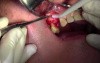 Flap Design & Pilot Hole - Implant Placement #5 - ID Screwplant System