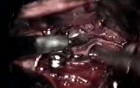 Brain Aneurysm Surgery Footage