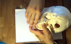 Mandible Fracture - Ivy Loop Table Top Maxilla