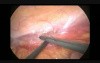 Laparoscopic Radical Nephrectomy In Kidney Cancer