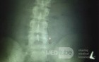 Ileus- Internal Hernia