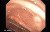 Adenocarcinoma of the Transverse Colon (4 of 5)