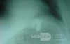 Large Gastric Varices (24 of 25)