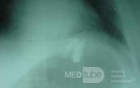 Large Gastric Varices (24 of 25)