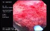 Radiation Proctosigmoiditis (9 of 14)