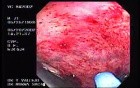 Radiation Proctosigmoiditis (9 of 14)