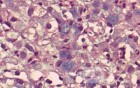 Gastric Cancer (15 of 15)