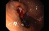 Gastric Varices - Endoscopic Ablation With Cyanoacrylate Glue (11 of 18)