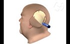 Craniotomy and Biopsy