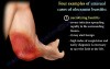 Unusual Bursitis of the Elbow - Video Lecture