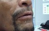 Maxillary Occlusal Rim Tryin - Speech - What To Look For.