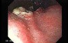 Esophageal Squamous Cell Carcinoma (3 of 5)