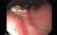 Esophageal Squamous Cell Carcinoma (3 of 5)