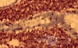 Gastric lymphoma with metastases to the duodenum (12 of 15)