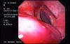 Barrett´s Esophagus -granuloma- (4 of 4)