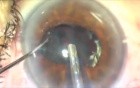 Fugo Plasma - Pearls of Blade Capsulotomy...New technology to solve surgical problems