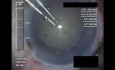 Cataract Surgery - Part 1