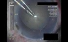 Cataract Surgery - Part 1