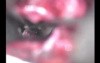 Microvascular Decompression of the Trigeminal Nerve