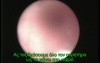 Ureteric Stone - Removal