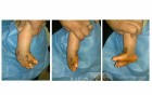 Cleft Foot 2