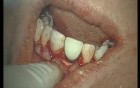 Temporary Crown Immediate Loaded (2/2)