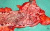 Severe case of Ischemic Colitis (19 of 19)