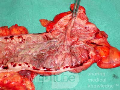Severe case of Ischemic Colitis (19 of 19)