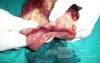 Endoscopy of Scirrhous Gastric Carcinoma involving the entire Fundus, Body and the Antrum (36 of 47)