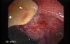 Status Post Rubber Band Ligation for Internal Hemorrhoids (6 of 7)