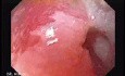 Longstanding gastroesophageal reflux disease (5 of 7)