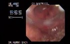 Gastric Adenocarcinoma - Obstruction 2