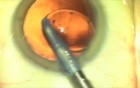 Fugo Plasma Blade Capsulotomy - Magic Capsulotomies