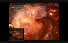 Transaxillary Robotic Total Thyroidectomy 