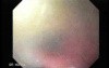 Tracheobronchitis - Bronchoscopic Image