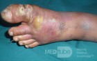 Infected Ulcer In The Big Toe Diabetic Man
